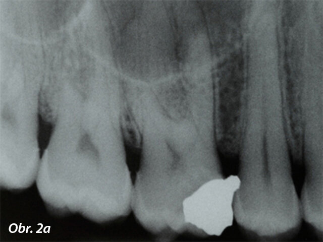 Úspěšná terapie je, když jsou plnicí materiály schopny pevně utěsnit prostor kořenových kanálků, a to i v případě více výstupů
