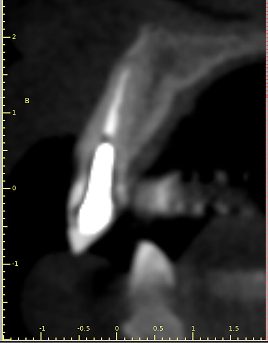 Fig. 2: The trajectory of the root
in relation to the alveolus can be visualised with a cross-sectional image.