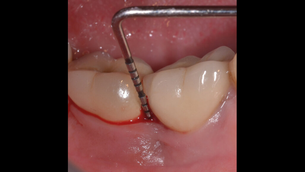 Perimplantite trattata con ozono stabilizzato in gel: case report