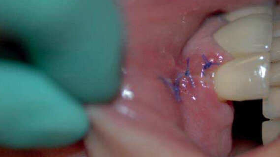 Reconstruction osseuse pré-implantaire par bloc d’os allogénique sur mesure