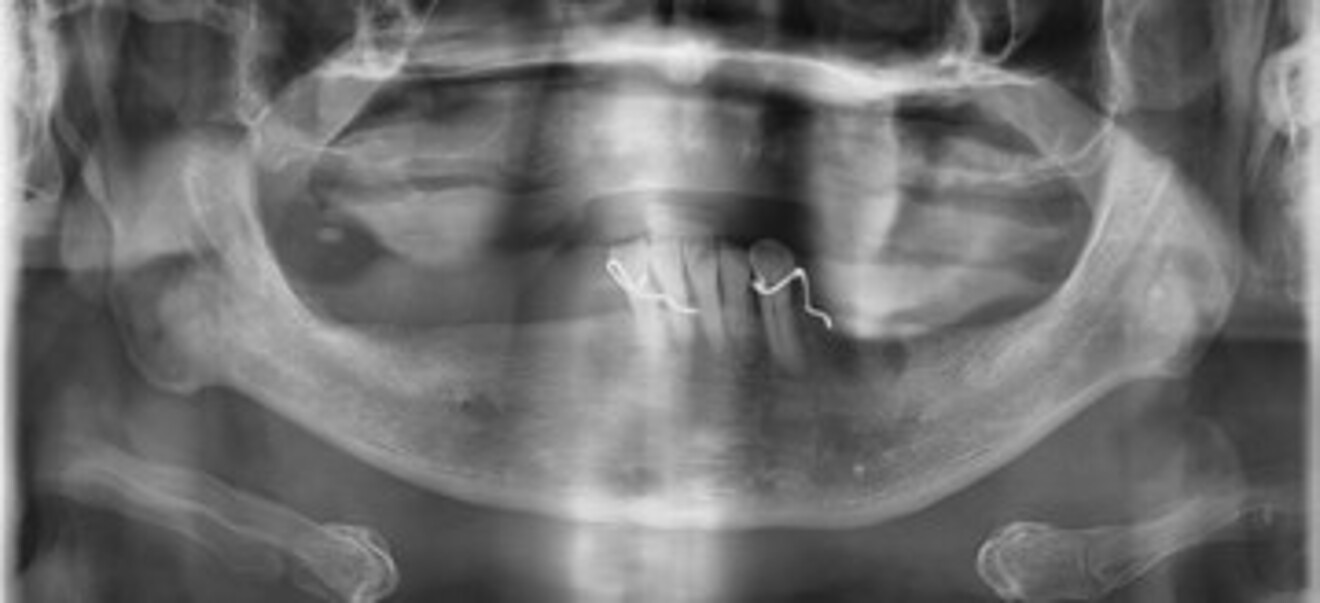 Fig. 4a: Pretreatment panoramic radiograph.
