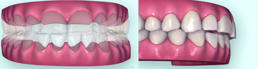 Fig. 4: Clinical situation after nine months of clear aligner therapy. Total of 2 mm of intrusion was achieved.