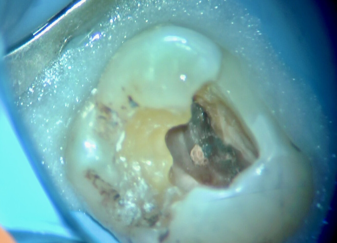 Fig. 14 : Vue sous microscope peropératoire montrant des débris organiques au niveau des orifices du canal MV.