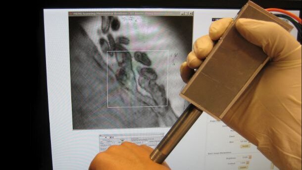 Une nouvelle sonde portable pour détecter précocement  le cancer de la bouche