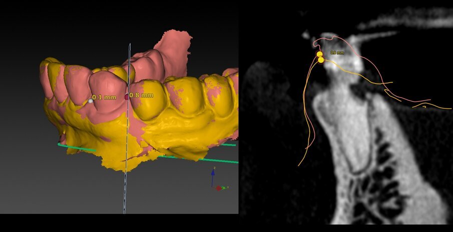 Figg. 22, 23_Matching degli STL pre e post per la valutazione delle modifiche a livello delle papille. La mesiale risulta mantenuta, mentre la distale subisce una piccola perdita pari a 0,8 mm.