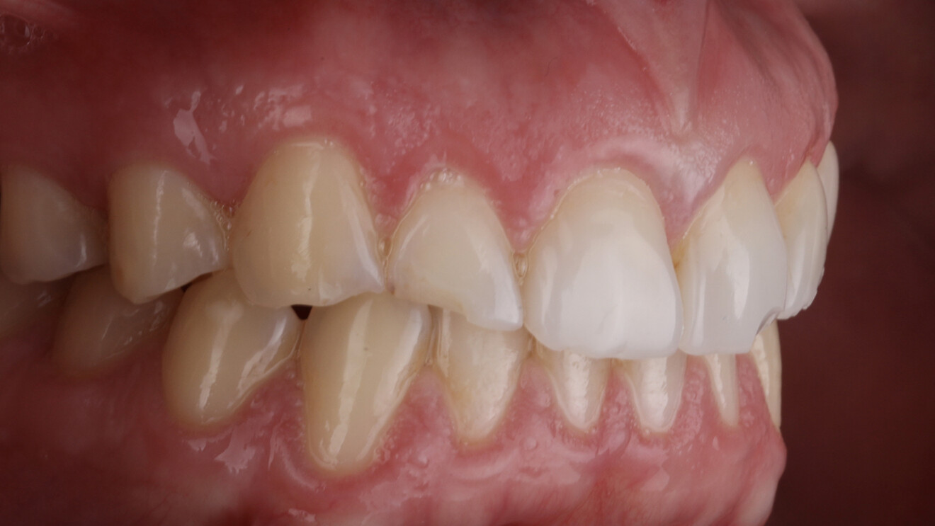 Fig. 1f: Left lateral intra-oral views with the teeth in intercuspation.