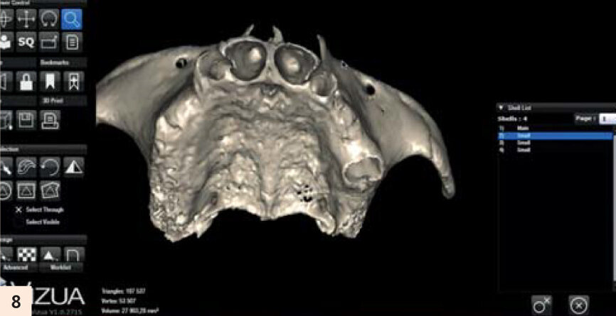 Entraînement sur la mâchoire imprimée en 3D par la Sapo d’après les fichiers DICOM’s.