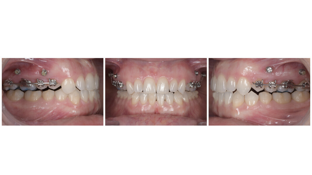Figs. 45a–c: Improvement of the anterior open bite thanks to vertical control and mandibular auto-rotation.