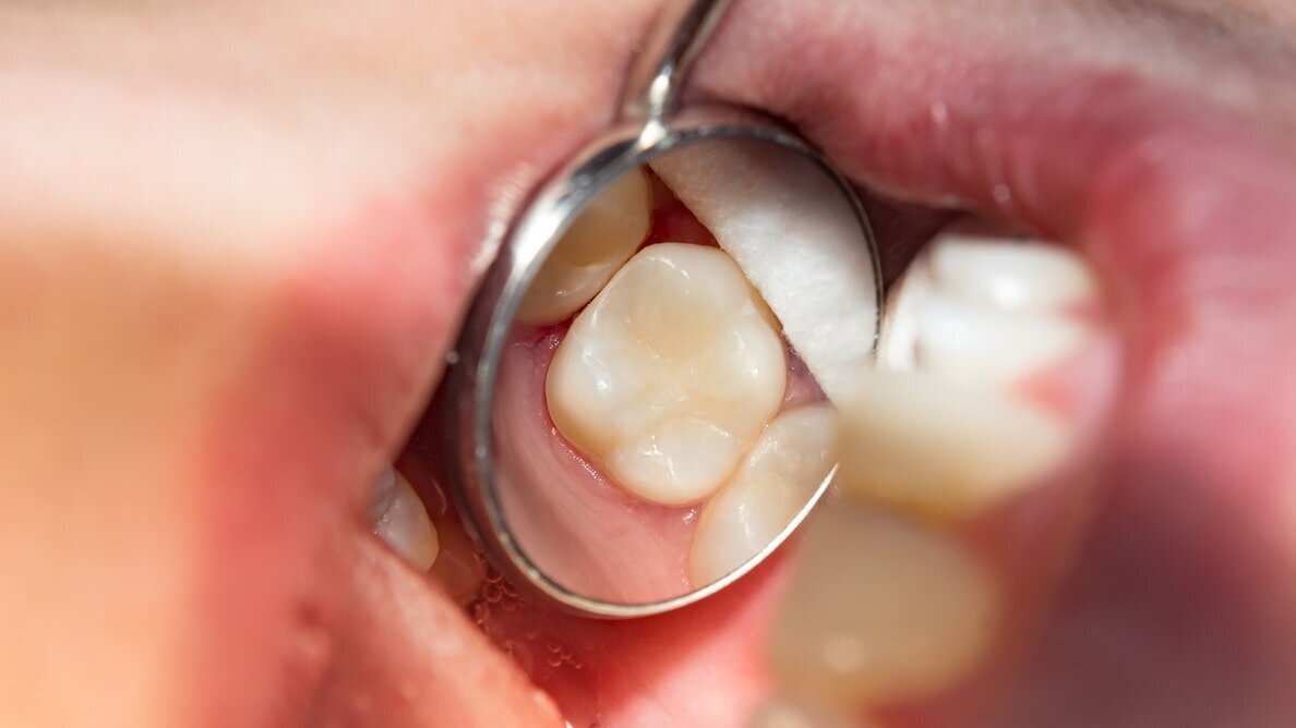 Glass hybrids versus composite: Efficacy and cost-effectiveness in a multicentre clinical study