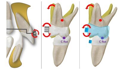 Alineadores: Biomecánica básica de los Ataches (2ª Parte)