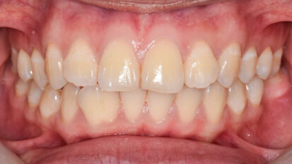 Vědci odhalili, jak mohou orální bakterie ovlivňovat agresivitu rakoviny tlustého střeva