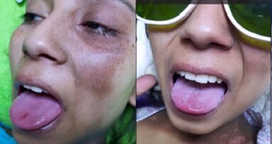 Perfil de pacientes oncológicos tratados con láser de baja intensidad