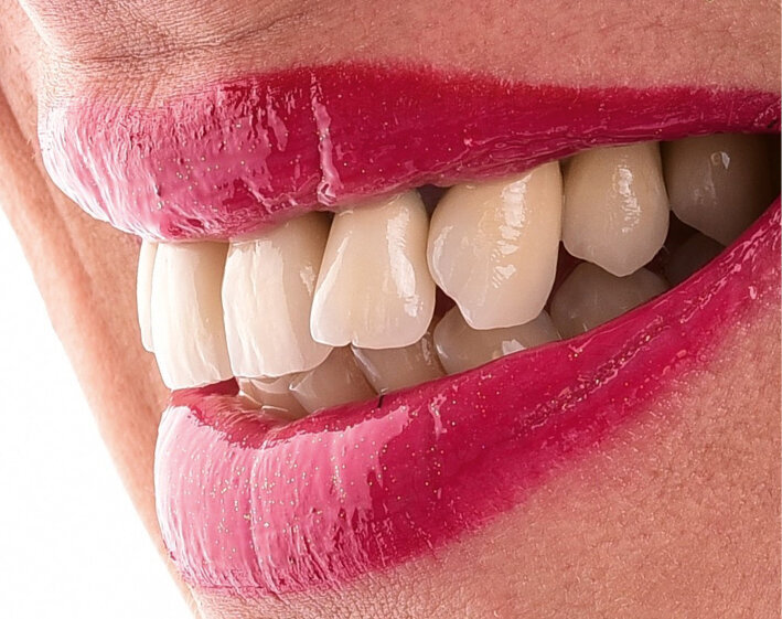 Fig. 18: The seated restorations (layered with IPS Style) harmoniously blend into the overall natural oral environment