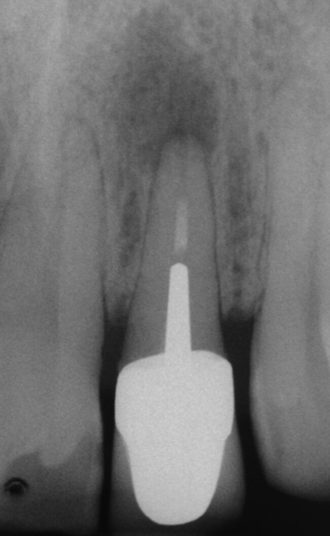 Fig. 4a: (a) Pre-op radiograph with a large periradicular lesion. (b) Periapical surgery. (c) MTA application with the MAP System and PD MTA White. (d) Condensation of the MTA with pluggers. (e) Mirror view of the root-end cavity filled with MTA. (f) Post-op radiograph showing the root-end filling.