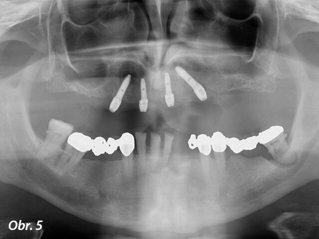 CT sken po chirurgickém zavedení čtyř implantátů v horní čelisti