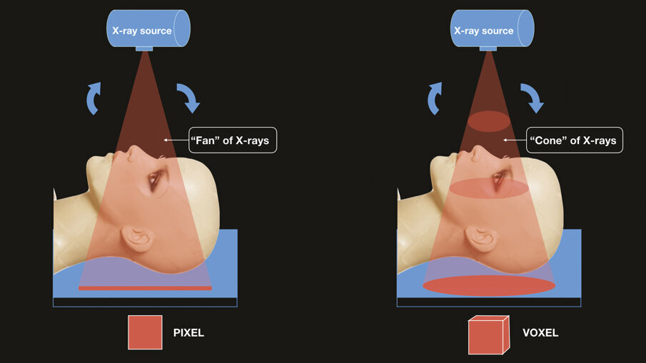 Fig. 3 - (Sinistra). La tradizionale TAC ha la sorgente di raggi X che ruota di 360° attorno al paziente circa 60 volte al minuto. Lo spessore di ogni sezione di immagine è determinata dalla distanza (di solito da 1,00 a 100,0 mm) in cui il paziente scorre sotto l’apparecchio. Questo espone il paziente a una massiva dose di radiazioni X. L’immagine digitale appare sul monitor in “pixel” che rappresentano un’immagine bidimensionale. (Destra). Una struttura conica che utilizza un fascio di raggi conico, ruota attorno alla testa del paziente. L’esposizione è simile a quella utilizzata per le radiografia dentali tradizionali, pertanto la dose alla quale il paziente è esposto viene ad essere notevolmente ridotta. L’immagine digitale appare sul monitor composta di “voxel” che mostrano una immagine tridimensionale.