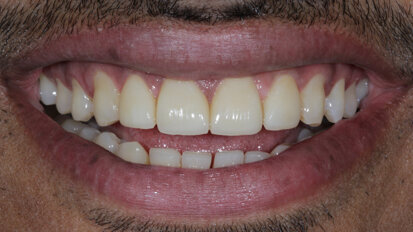 Designing smiles and Changing lives with Porcelain Laminate Veneers