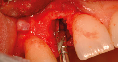 Tecnica post-estrattiva: i suoi vantaggi
