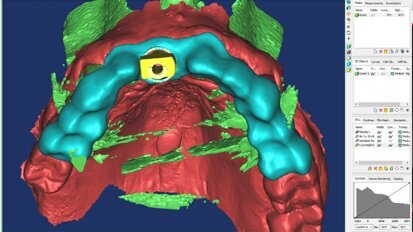 L’Intelligenza Artificiale e la Realtà Aumentata nella moderna pianificazione implantare: case report