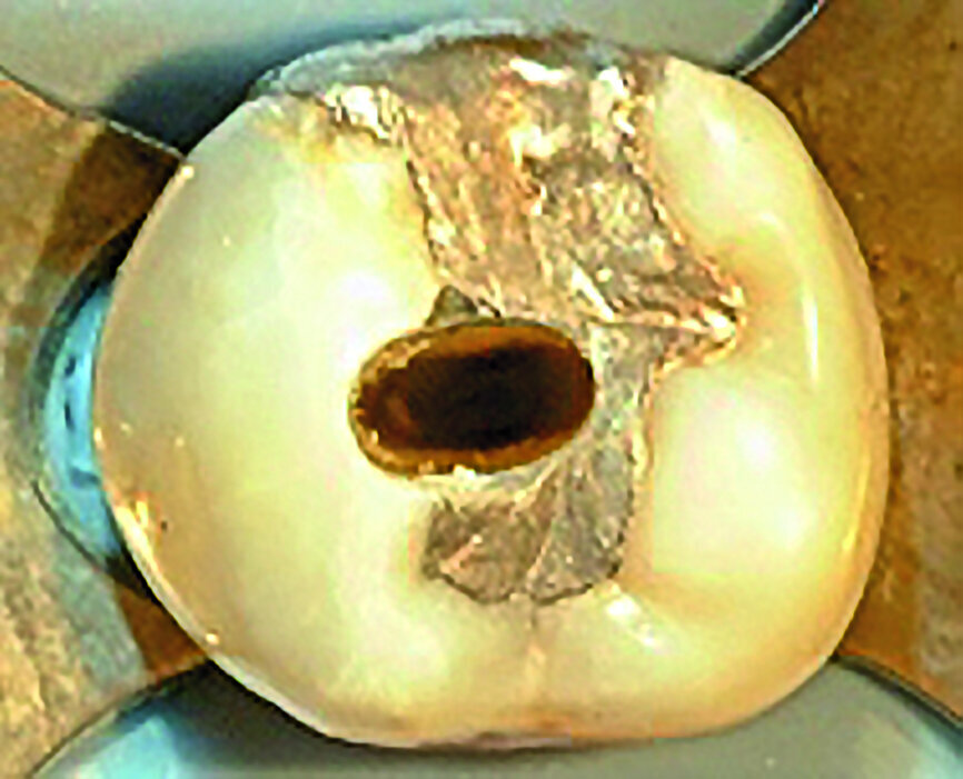 Fig. 2 : Prémolaire inférieure avec cavité d’accès ovale, allongée vers un seul canal radiculaire. À noter le décalage de la cavité d’accès vers les crêtes cuspidiennes vestibulaires d’appui et à courte distance de la cuspide guide linguale, mais centrée sur la structure radiculaire, comme le confirme le crampon pour digue en caoutchouc engagé dans la jonction amélo-cémentaire. 