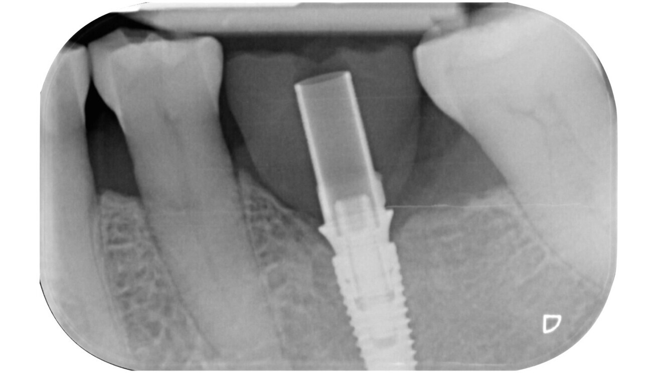 Fig. 15: Radiographic evaluation of the restoration in place.