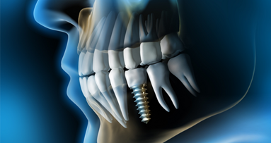Schweizer Implantatmarkt im Umbruch?