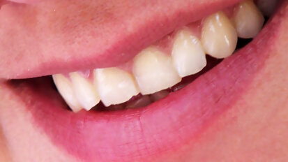 Aantal vrouwen met mondkanker toegenomen