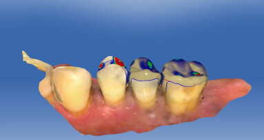 Mill, polish, seat! Indirect procedures in the dental workflow