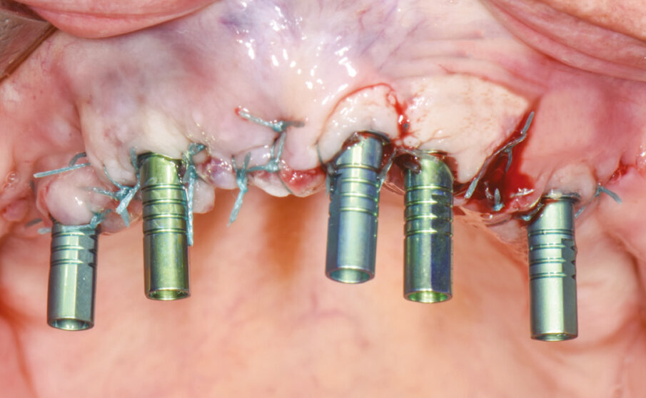 Fig. 5 - Cilindri da incollaggio posizionati sopra i monconi MUA già definitivamente fissati negli impianti.