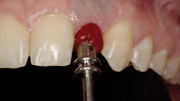 Zastosowanie techniki CAD/CAM do zindywidualizowania łącznika standardowego