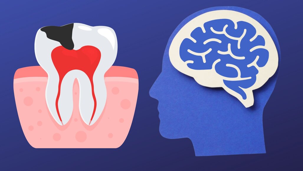 Impact of early childhood caries on mental development ​