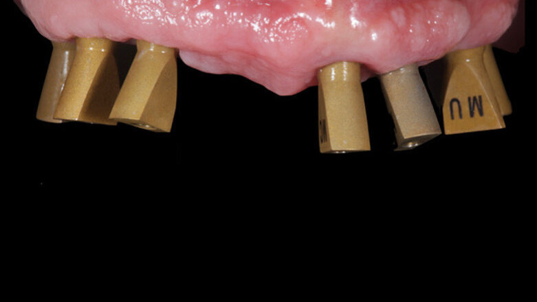 Dental implant abutment design is “a small stone in the whole mosaic”