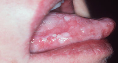 Nel cancro orale  la chiave del successo è nella diagnosi precoce e questa è affidata all’odontoiatra