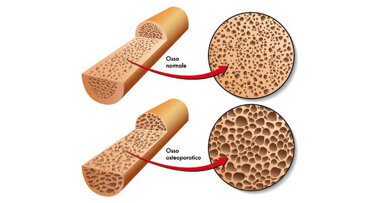 Osteoporose und Zahnersatz: Was Patienten beachten sollten