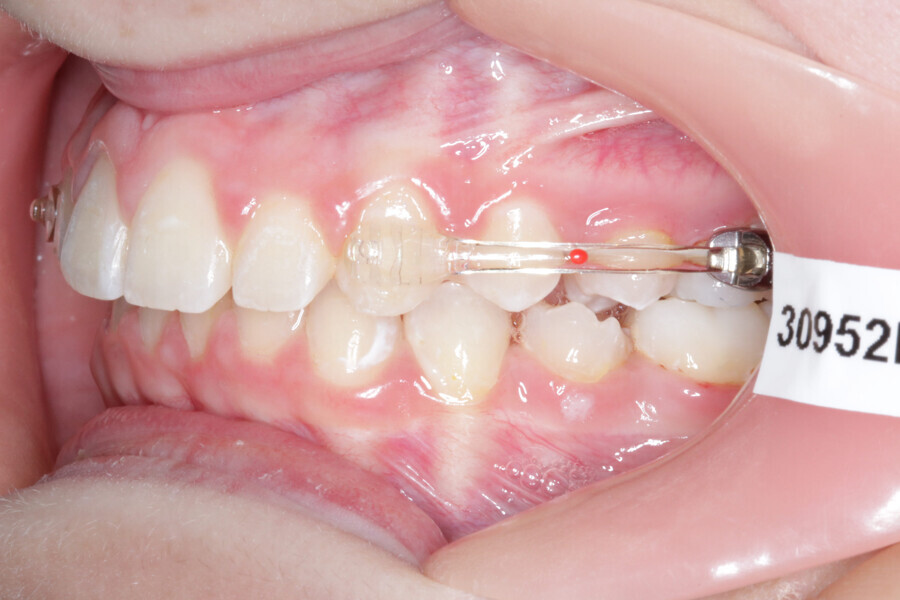 Fig. 7: Placement of the Carriere Motion 3D Clear Class II appliance.