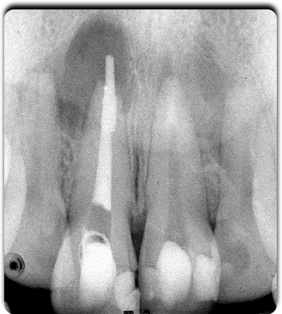 Fig. 3 - Lo stato endodontico iniziale.