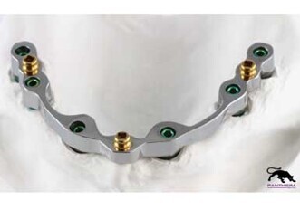 Threaded, spherical interchangeable attachments have threaded titanium sleeve option Threaded, spherical interchangeable attachments have threaded titanium sleeve option