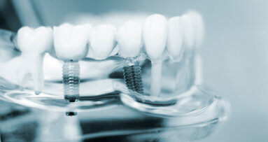 Researchers combine orthopaedic and dental expertise to improve implant longevity