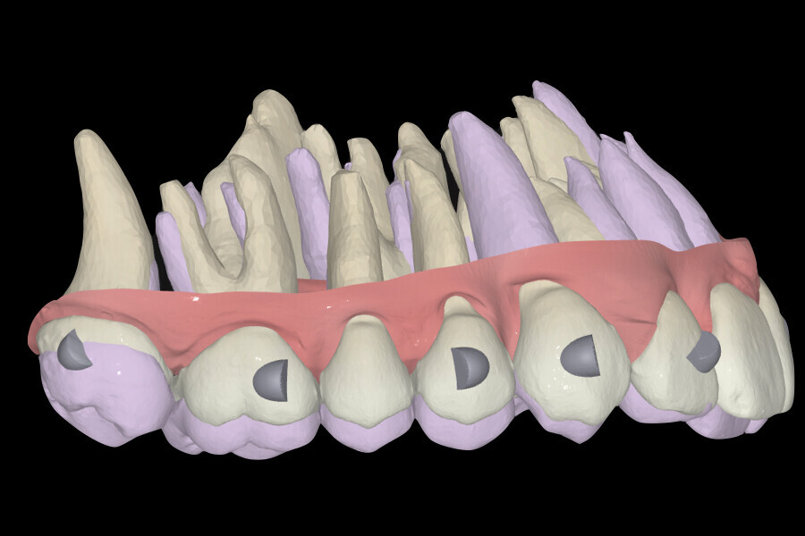 Fig. 28: 3D superimposition of the planned intrusive movements.