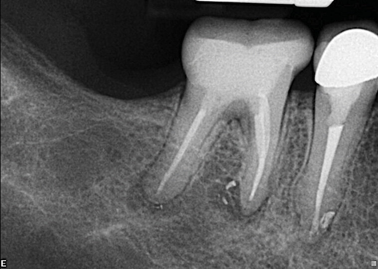Slučaj 1 – Slika br. 3: Periapikalni kontrolni Rtg snimak nakon godinu dana od tretmana