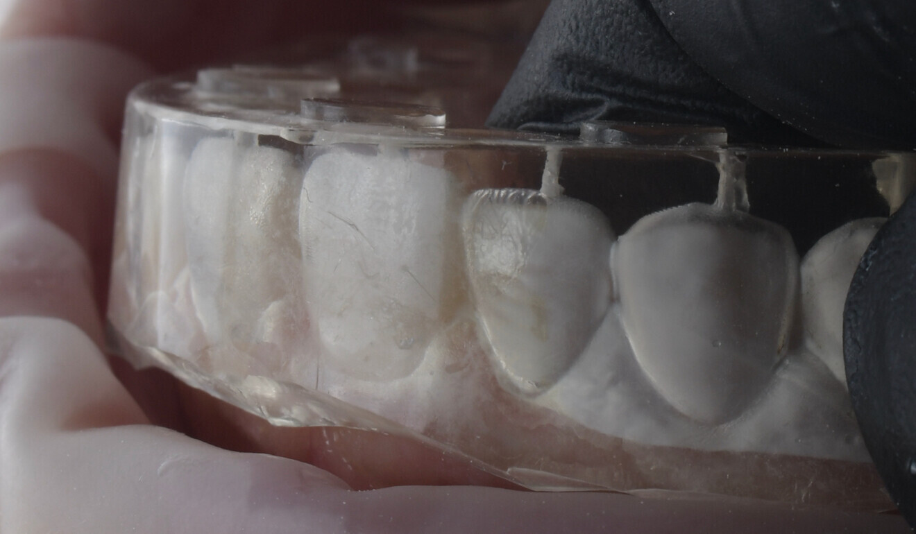 Fig. 14: Silicone index placed over the teeth, including the tooth with the defect.