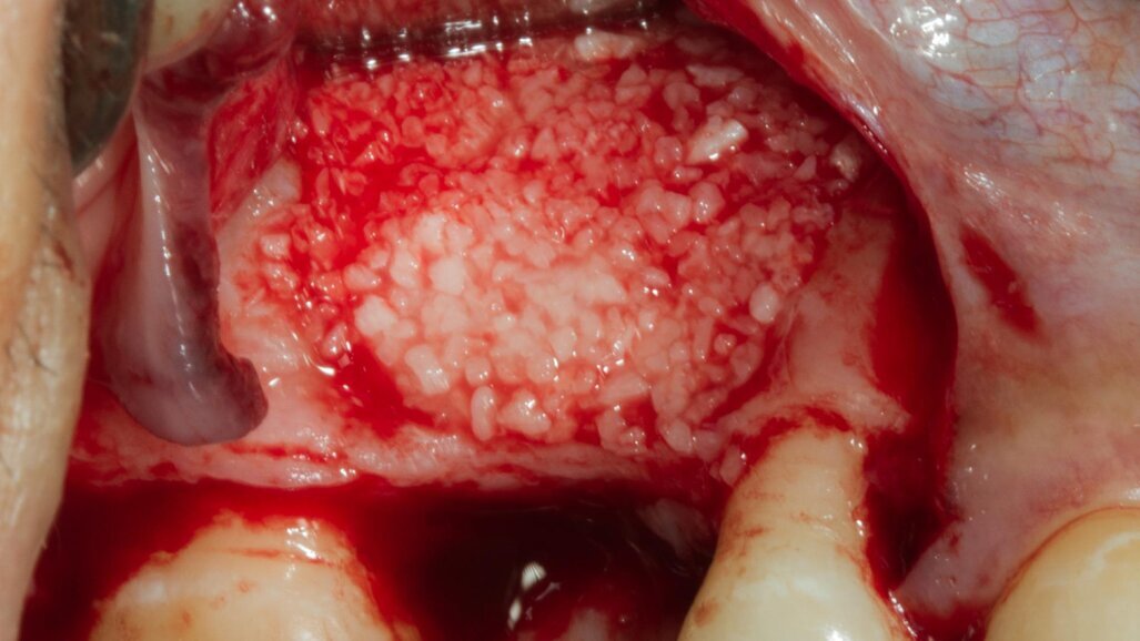 Rigenerazione ossea orizzontale con lamina corticale collagenata stabilizzata con colla di fibrina e viti da osteosintesi: case report