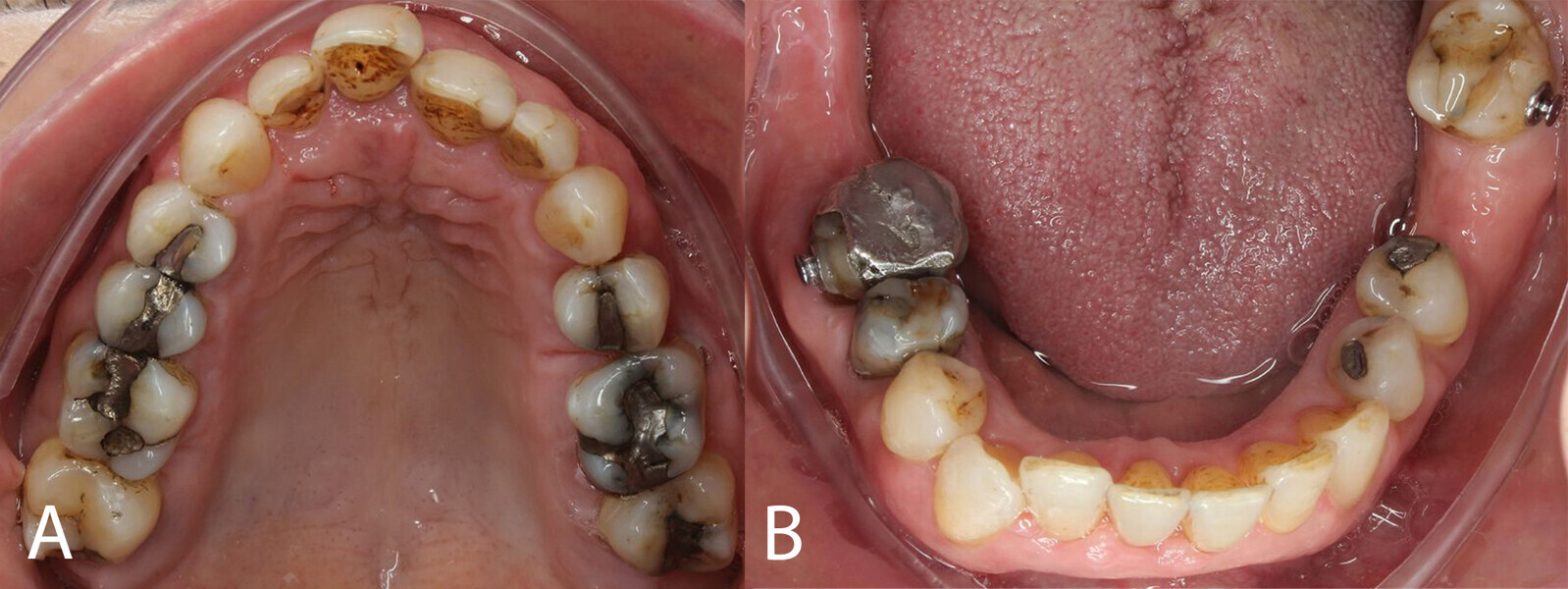 Figs. 3a & b: Occlusal views. (a) Maxillary view. (b) Mandibular view.
