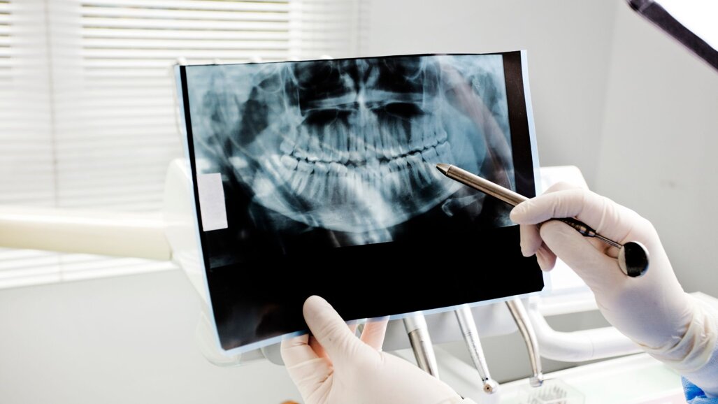 Developmental dental anomalies in offspring linked to consanguineous marriages, study finds