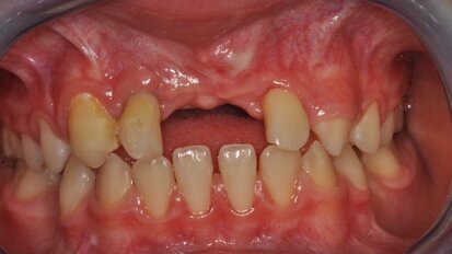 Autotransplantacja jako metoda autogennej rekonstrukcji ubytków wyrostka zębodołowego