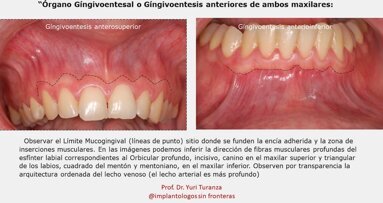 La implantología que no vemos