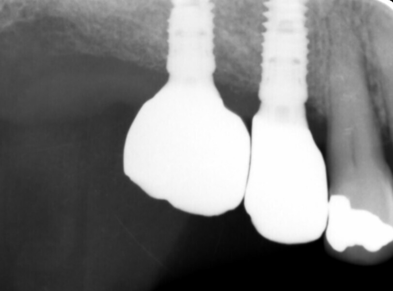 Fig. 16: Radiograph to verify correct seating of the restorations.