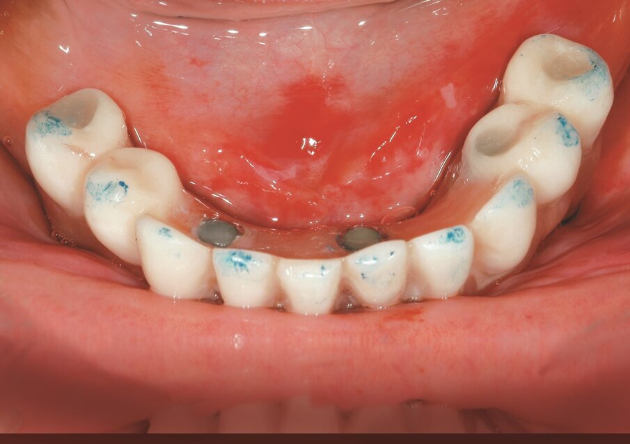 Fig. 1_Protesi a carico immediato con contatti bilaterali simultanei e puntiformi su tutti i denti.