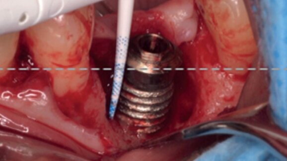 Surgical treatment of circumferential and semicircumferential defects due to periimplantitis: A prospective case series cohort study