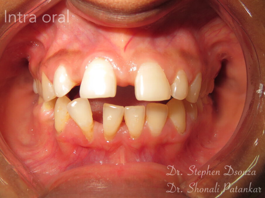 Fig. 2: intra-oral view.